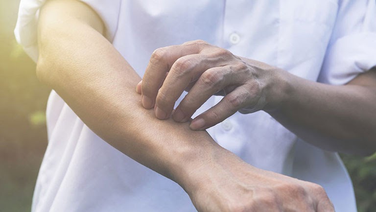 Nổi mề đay có thể khởi phát do các kích thích cơ học của người bệnh lên làn da