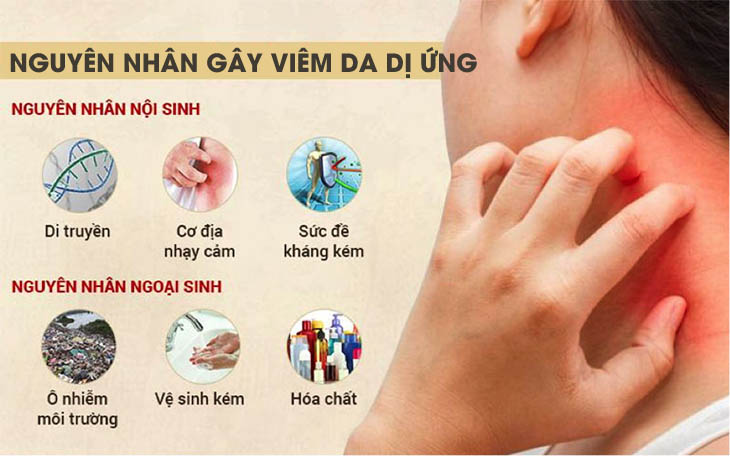 nguyen nhan viem da di ung