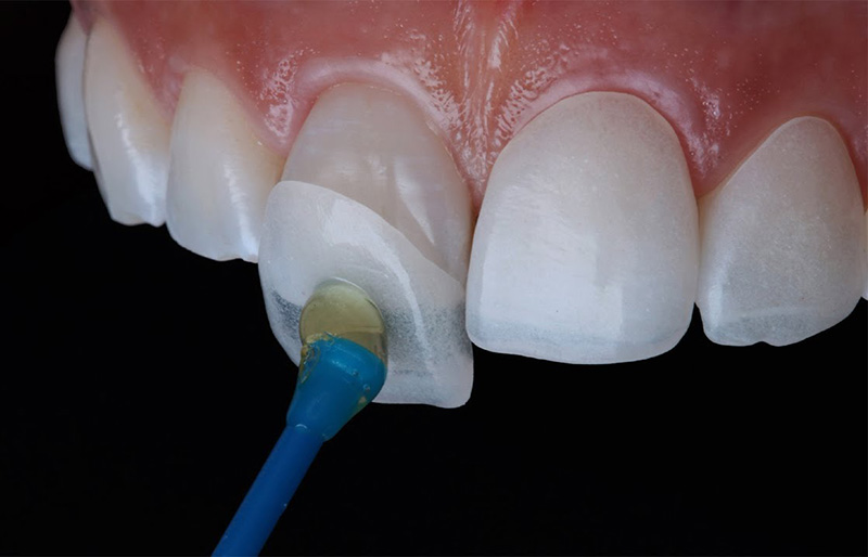dan veneer1