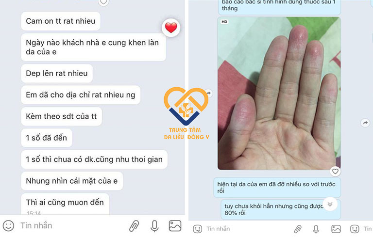 feedback chua viem da tiep xuc nhat nam an bi thang 768