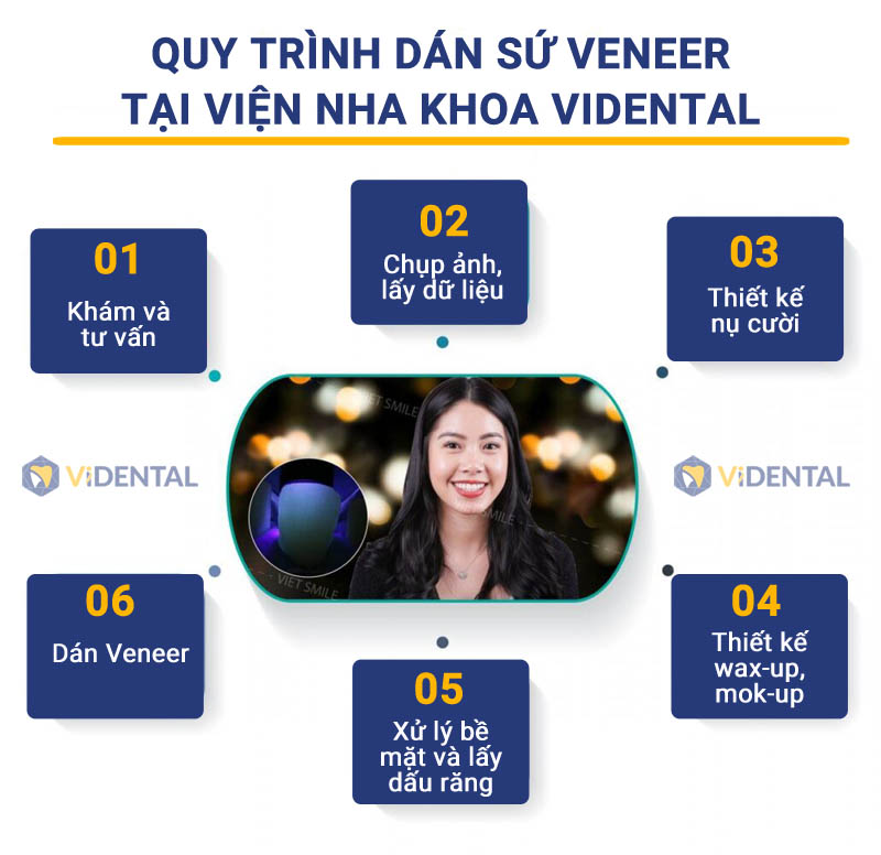 quy trinh dan su veneer videntalr