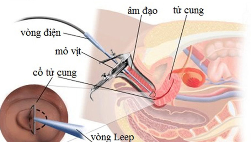 dieu tri viem lo tuyen