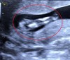 Hình ảnh ghi nhận trường hợp thai nhi mắc hội chứng “người cá” trên siêu âm