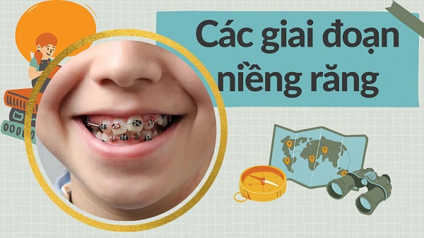 Các giai đoạn niềng răng diễn ra bao lâu?