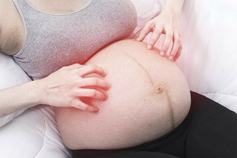 Nổi mề đay khi mang thai, sau sinh: Nguyên nhân, triệu chứng và cách điều trị an toàn