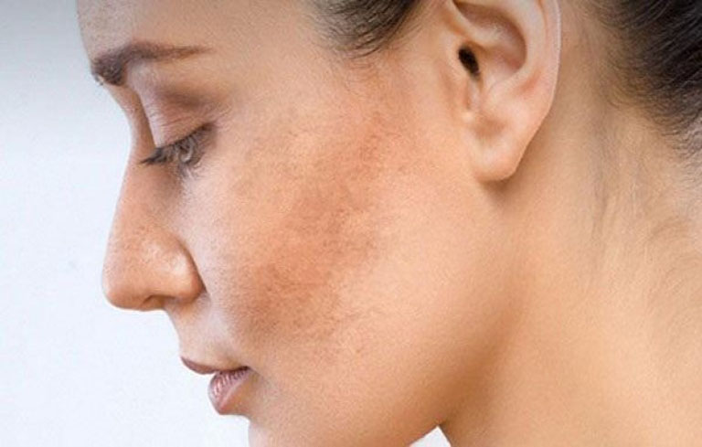 da mặt bị sạm đen là bệnh gì