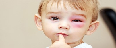 Adenovirus là một loại vi-rút có thể gây bệnh ở mọi lứa tuổi, đặc biệt là trẻ nhỏ, người cao tuổi và người có sức đề kháng kém. Ảnh minh hoạ